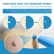 Skin Tag Remover Kit 2 In 1 For Micro To Large (2 Mm - 8 Mm  1 Set) Wukusy
