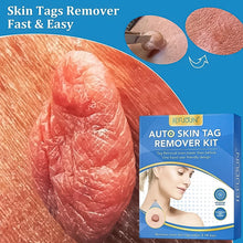 Skin Tag Remover Kit 2 In 1 For Micro To Large (2 Mm - 8 Mm  1 Set) Wukusy