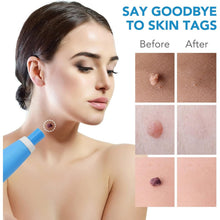 Skin Tag Remover Kit 2 In 1 For Micro To Large (2 Mm - 8 Mm  1 Set) Wukusy