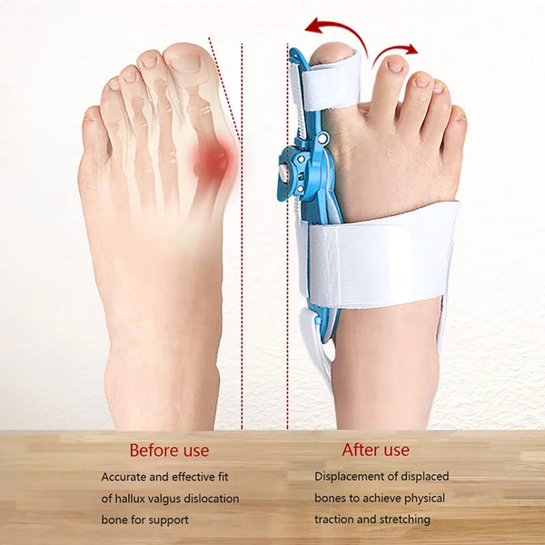 Bunion Support Splint – Adjustable Hallux Valgus Corrector for Men & Women